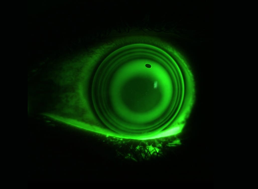 Lente a contatto ortocheratologica